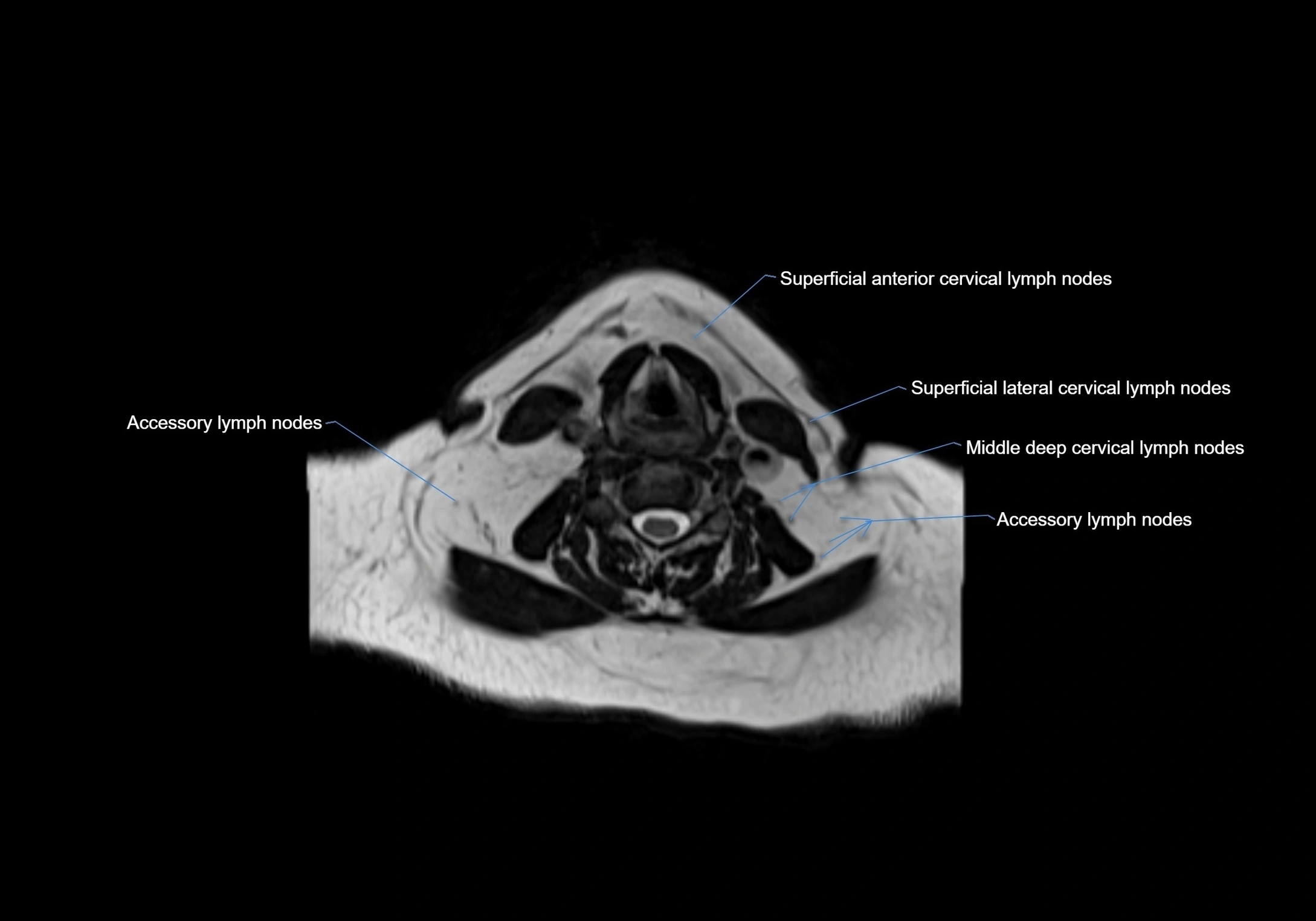 Neck axial  lymph node cross sectional MRI anatomy 3T MRI  image-img-00001-00063.webp